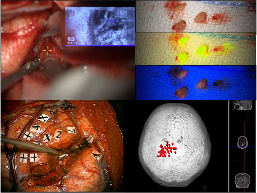 Immagini dell'attività Clinica e Casistica del Prof. Alessandro Della Puppa Neurochirurgo