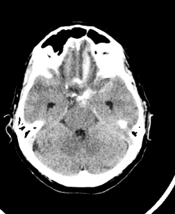 TAC di un paziente con emorragia per auneurisma cerebrale
