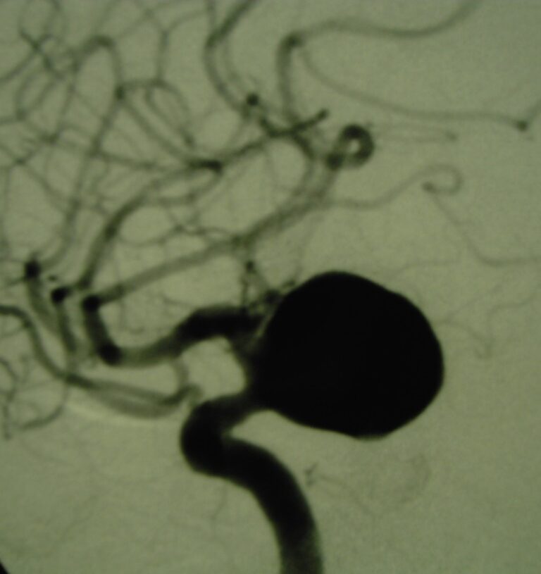 Immagine di un auneurisma cerebrale