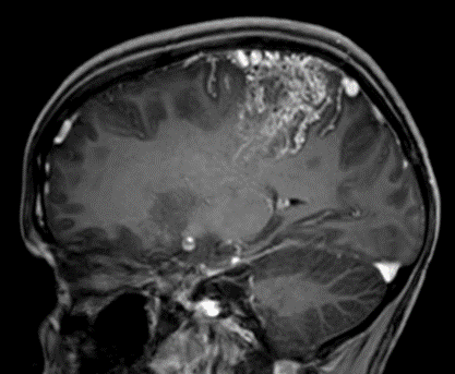 Immagine di una sezione di un cranio affetto da MAV