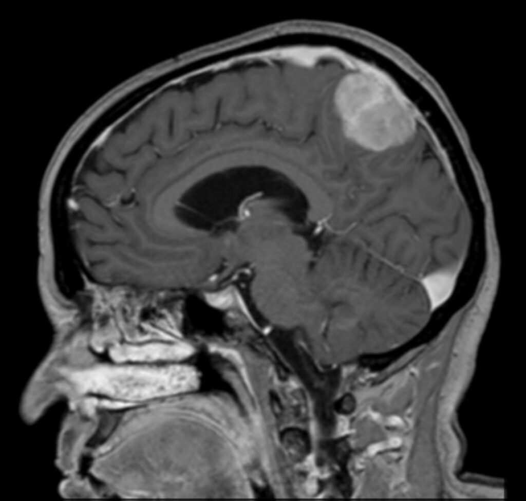 Immagine di un cranio affetto da un meningioma