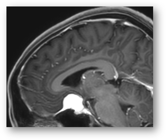 Immagine di un cranio affetto da meningioma