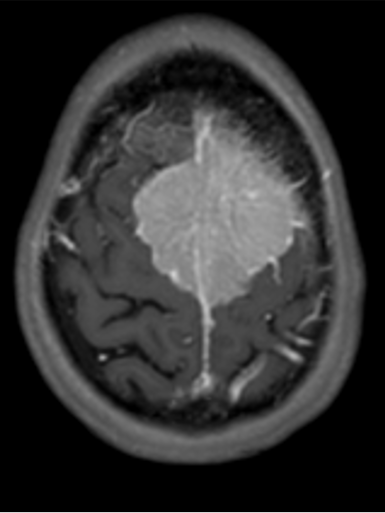 Immagine di una sezione del cranio affetto da meningioma