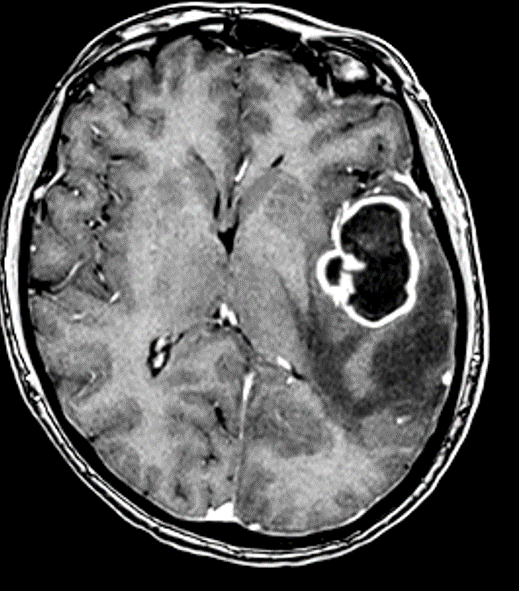 Immagine di una sezione del cranio con una metastasi cerebrale