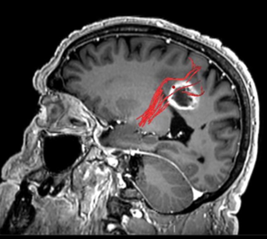 Immagine della sezione di un cranio con metastasi
