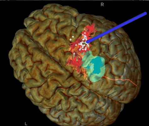 Immagine con fluorescanza per indivisuare la zona da operare