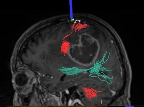 Immagine Intervento sulla metatstasi cerebrali