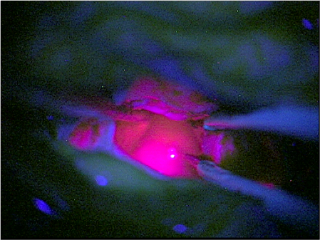 Immagine dell'utilizzo della tecnologia Fluorescenza 5-ALA in un inervento del Prof. Alessandro Della Puppa
