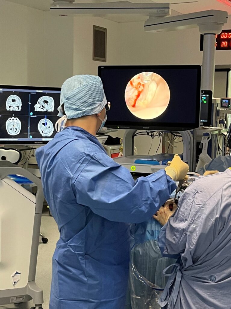 Immagine di un intervento con utilizzo di Endoscopia Cerebrale nel centro del Prof. Alessandro Della Puppa