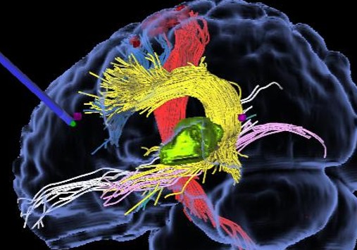 Immagine della tecnica di chirurgia mini-invasiva utilizzata dal Prof. Alessandro Della Puppa