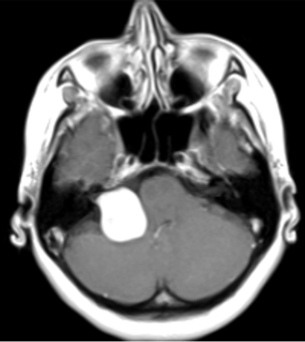Immagine di un cervello con Neurinoma Acustico