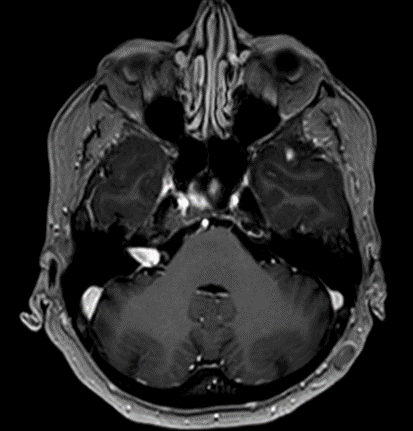 Immagini di una RM con neurinoma acustico