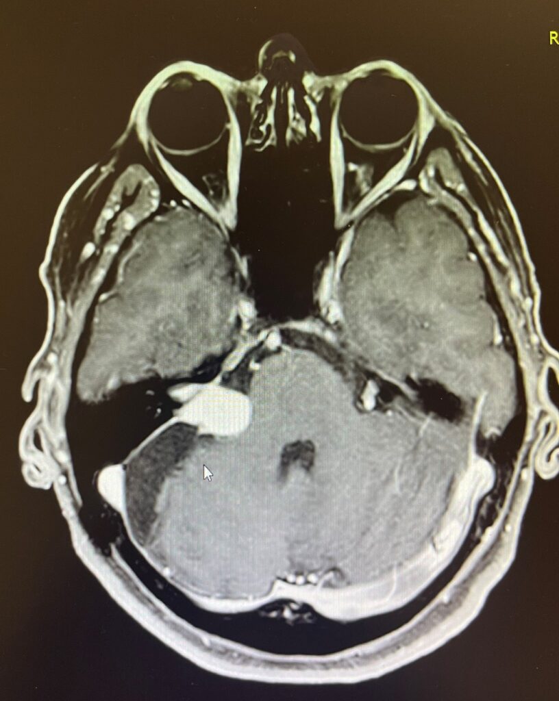 Immagine RM di un neurinoma acustico