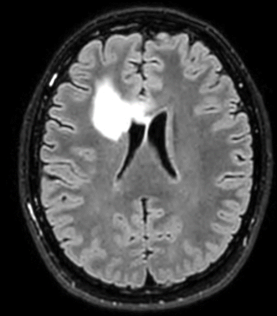 Immagine di una sezione del cranio con Glioma di Basso Grado del Prof. Alessandro Della Puppa