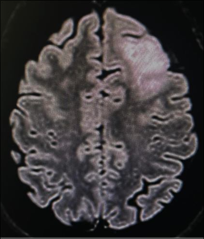 Immagine di una sezione del cranio con Glioma di Basso Grado del Prof. Alessandro Della Puppa