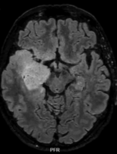 Immagine di una sezione del cranio con Glioma di Basso Grado del Prof. Alessandro Della Puppa
