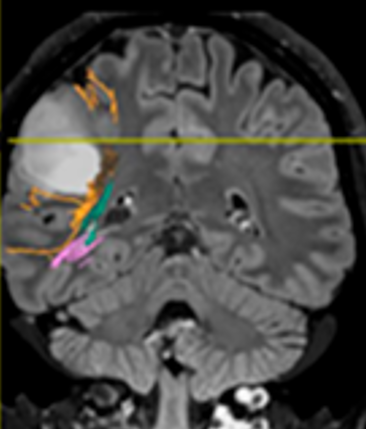 Immagine di una sezione del cranio con Glioma di Basso Grado del Prof. Alessandro Della Puppa
