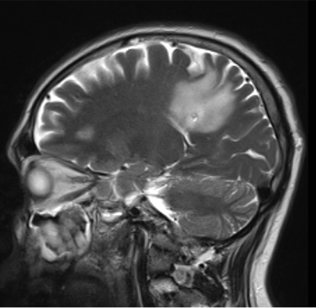 Immagine di una sezione del cranio con Glioma di Basso Grado del Prof. Alessandro Della Puppa