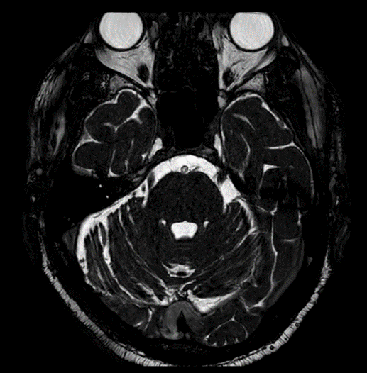 Immagine RM in sezione del cranio di un paziente affetto da Nevralgia del Trigemino del Prof. Alessandro Della Puppa