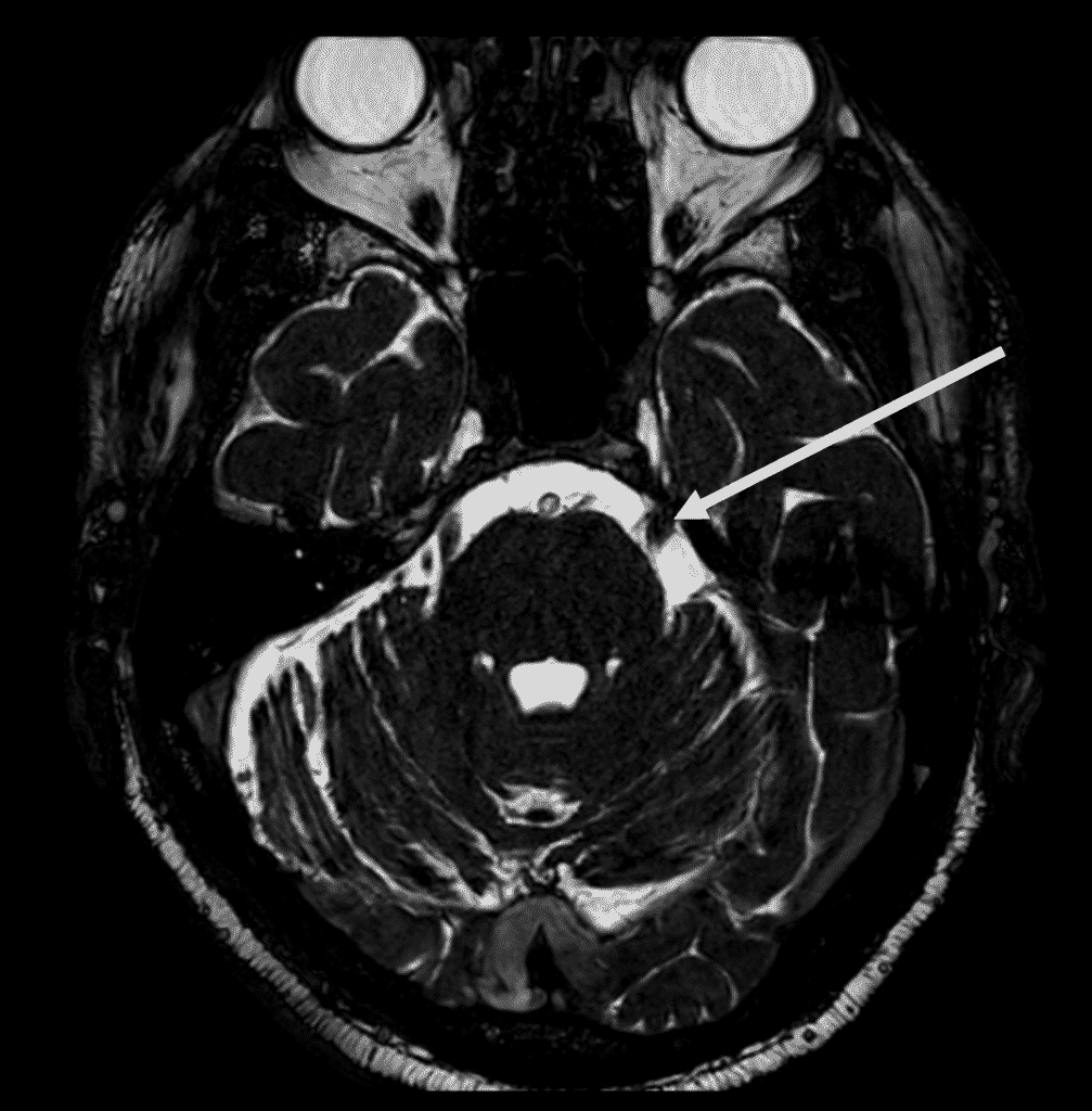 Immagine RM in sezione del cranio di un paziente affetto da Nevralgia del Trigemino del Prof. Alessandro Della Puppa