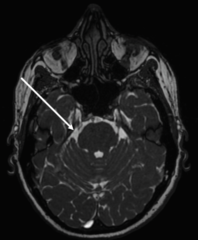 Immagine RM in sezione del cranio di un paziente affetto da Nevralgia del Trigemino del Prof. Alessandro Della Puppa