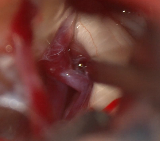 Dettaglio di un nervo trigemino, dopo il trattamento del Prof, Alessandro Della Puppa