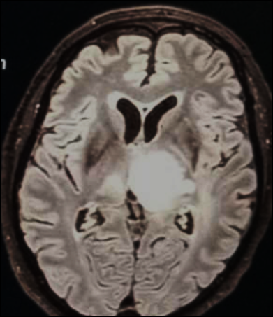 Immagine di una sezione del cranio con Glioma di Basso Grado del Prof. Alessandro Della Puppa