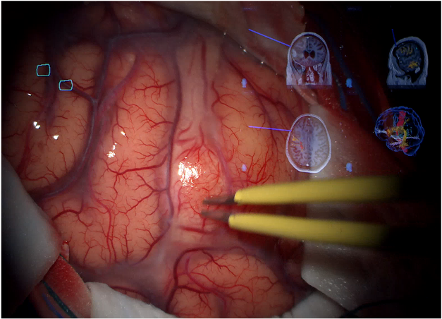 Dettaglio un immagino di un cervello durante l'operazione con i dettagli di realtà aumentata