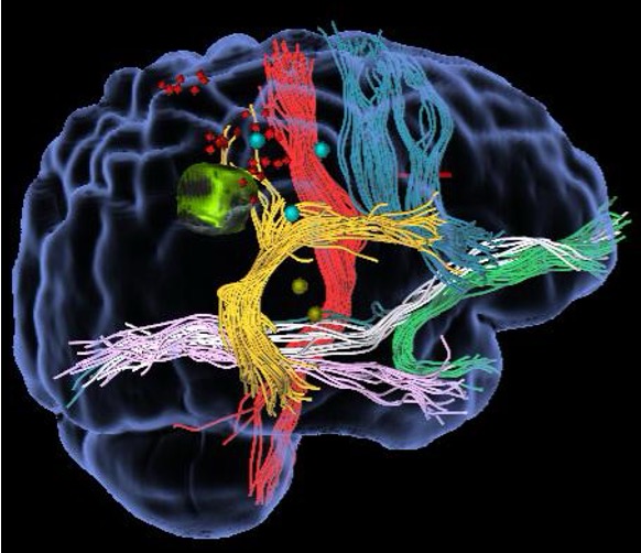 Immagine di un cranio che rappresenta una TMS Navita del Prof. Alessandro Della Puppa