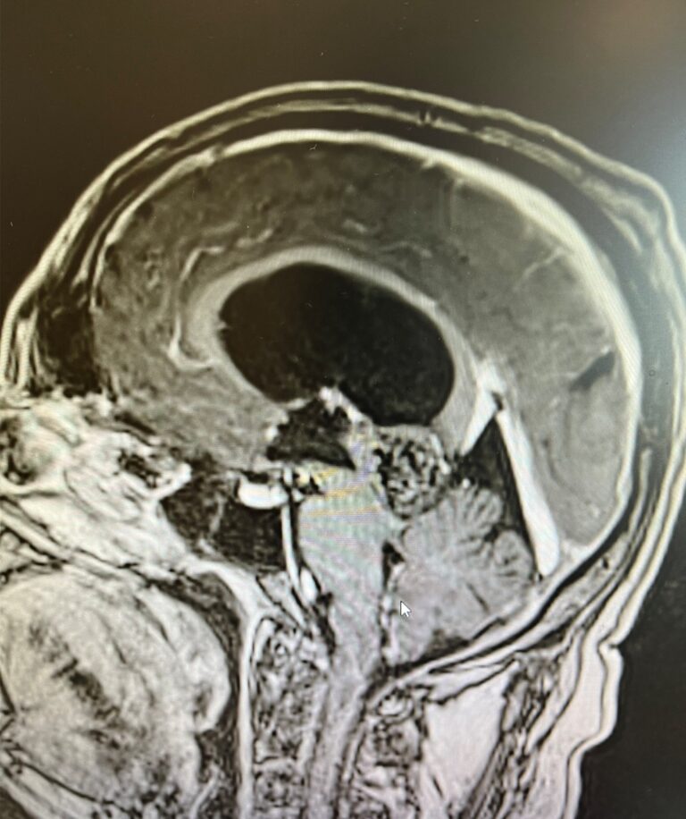 Foto di un cranio con patologia idrocefalo facciale trattata dal Prof. Alessandro Della Puppa