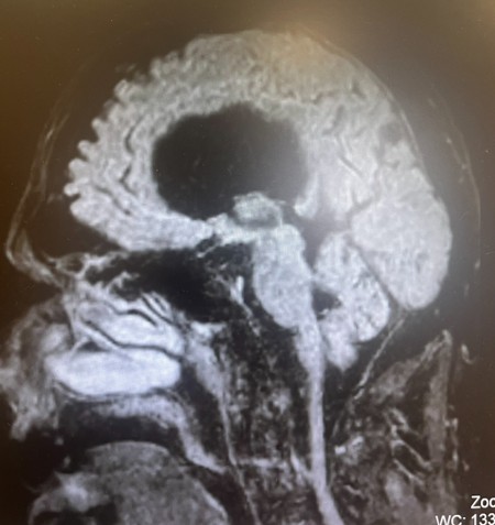 Foto di un cranio con patologia idrocefalo facciale trattata dal Prof. Alessandro Della Puppa