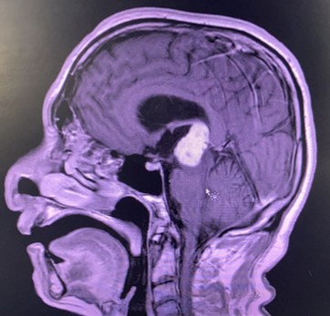 Foto di un cranio con patologia idrocefalo facciale trattata dal Prof. Alessandro Della Puppa