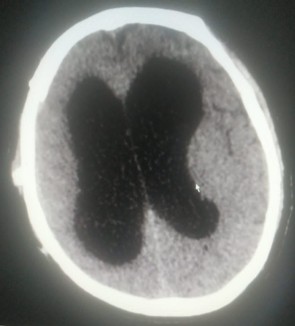 Foto di un cranio con patologia idrocefalo facciale trattata dal Prof. Alessandro Della Puppa