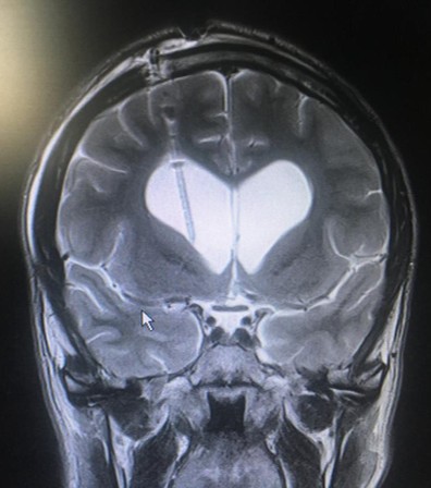 Foto di un cranio con patologia idrocefalo facciale trattata dal Prof. Alessandro Della Puppa