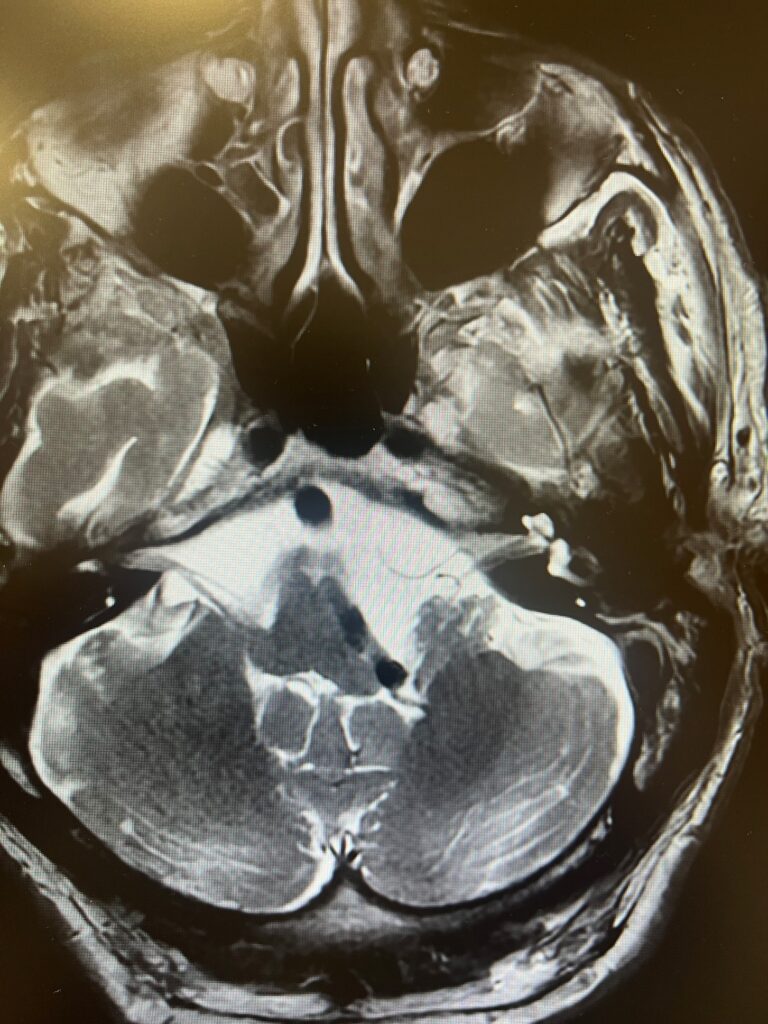 Foto di un cranio con patologia emispasmo facciale trattata dal Prof. Alessandro Della Puppa
