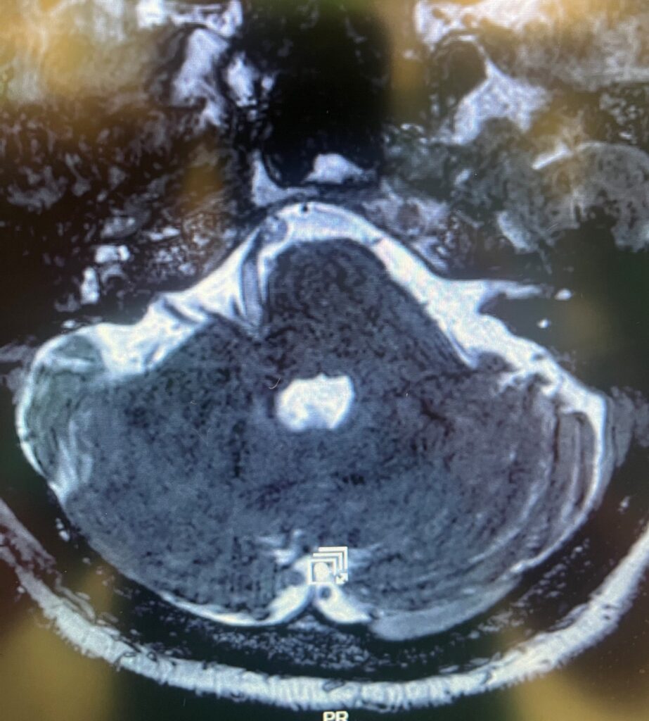 Foto di un cranio con patologia emispasmo facciale trattata dal Prof. Alessandro Della Puppa