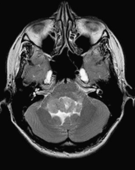 Foto di un cranio con patologia emispasmo facciale trattata dal Prof. Alessandro Della Puppa