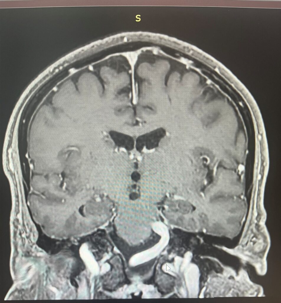 Foto di un cranio con patologia emispasmo facciale trattata dal Prof. Alessandro Della Puppa